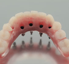 Denture Implant Solutions