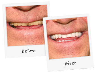 Guelph Denture Clinic Before and After